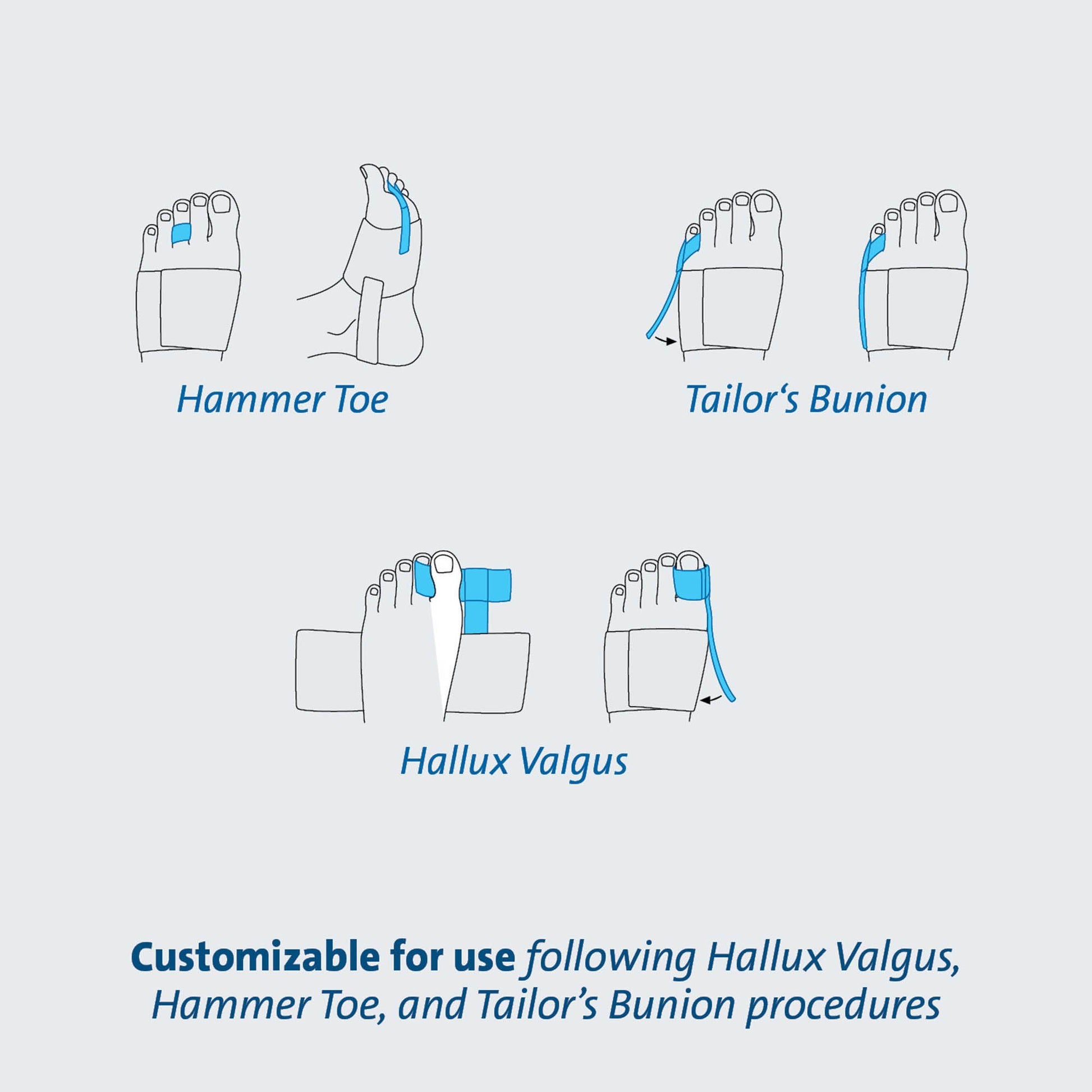 TAS™ Toe Splint, One Size Fits Most